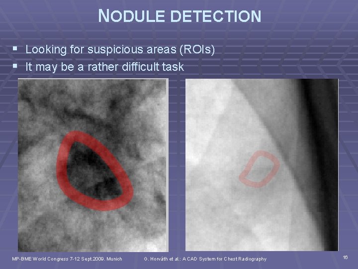 NODULE DETECTION § Looking for suspicious areas (ROIs) § It may be a rather