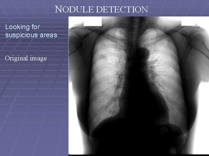NODULE DETECTION Looking for suspicious areas Original image 