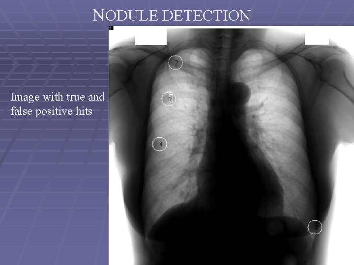 NODULE DETECTION Image with true and false positive hits 