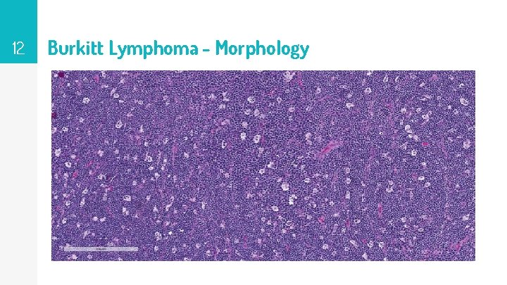 12 Burkitt Lymphoma - Morphology 