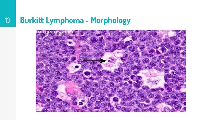 13 Burkitt Lymphoma - Morphology 