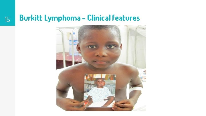 15 Burkitt Lymphoma - Clinical features 