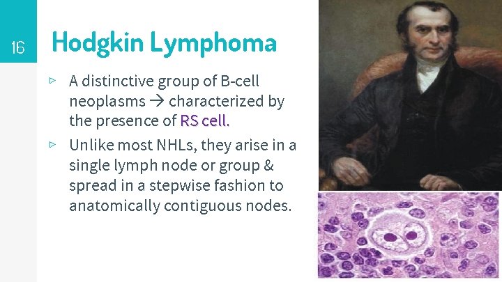 16 Hodgkin Lymphoma ▹ A distinctive group of B-cell neoplasms characterized by the presence