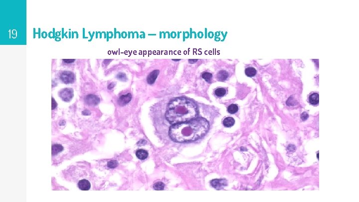 19 Hodgkin Lymphoma – morphology owl-eye appearance of RS cells 