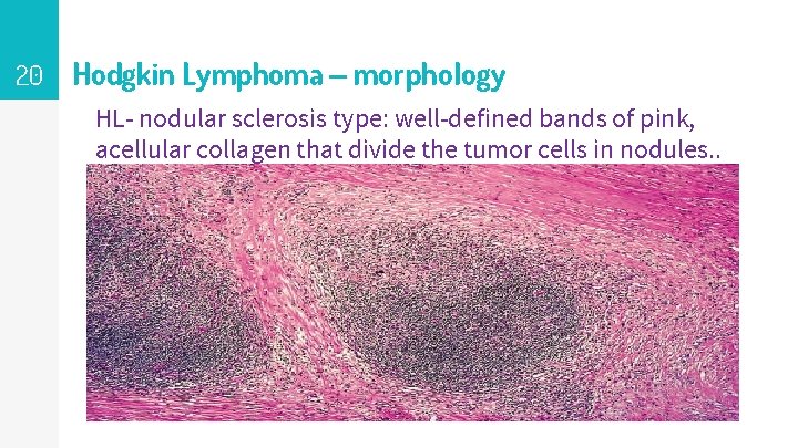 20 Hodgkin Lymphoma – morphology HL- nodular sclerosis type: well-defined bands of pink, acellular