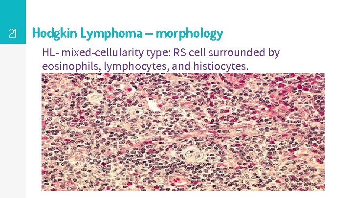 21 Hodgkin Lymphoma – morphology HL- mixed-cellularity type: RS cell surrounded by eosinophils, lymphocytes,
