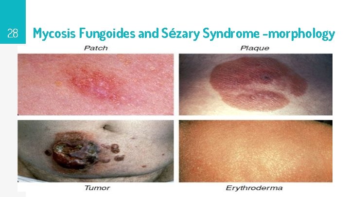 28 Mycosis Fungoides and Sézary Syndrome -morphology 