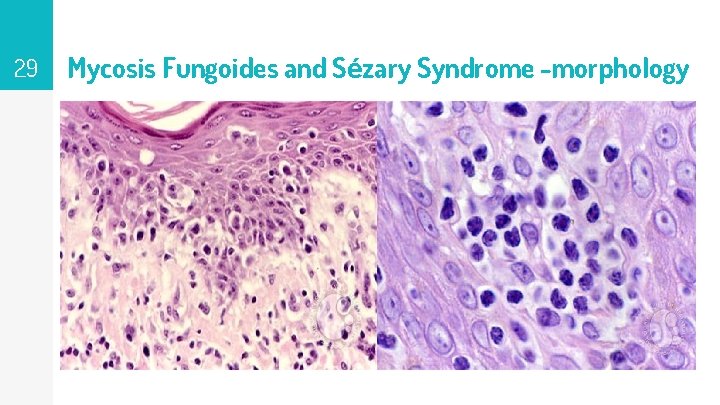 29 Mycosis Fungoides and Sézary Syndrome -morphology 