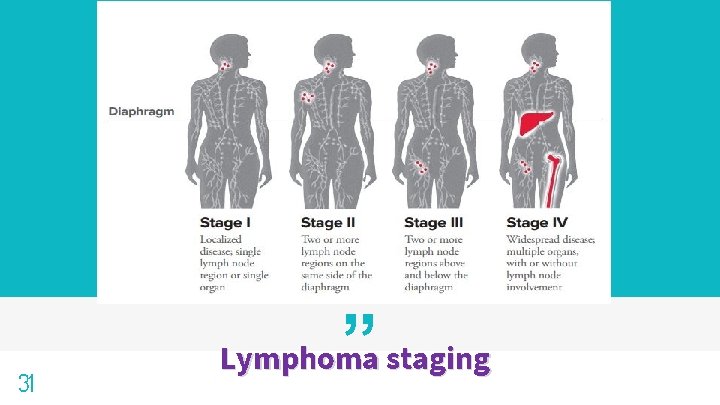 31 ” Lymphoma staging 