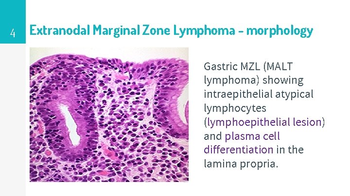 4 Extranodal Marginal Zone Lymphoma - morphology Gastric MZL (MALT lymphoma) showing intraepithelial atypical