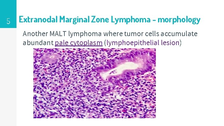 5 Extranodal Marginal Zone Lymphoma - morphology Another MALT lymphoma where tumor cells accumulate