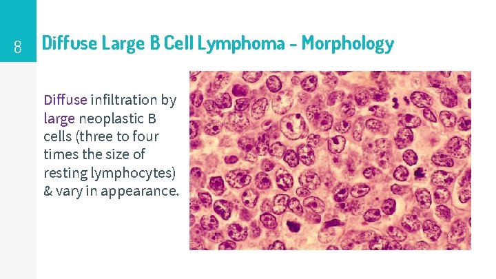 8 Diffuse Large B Cell Lymphoma - Morphology Diffuse infiltration by large neoplastic B