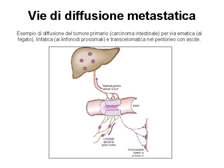 Vie di diffusione metastatica Esempio di diffusione del tumore primario (carcinoma intestinale) per via