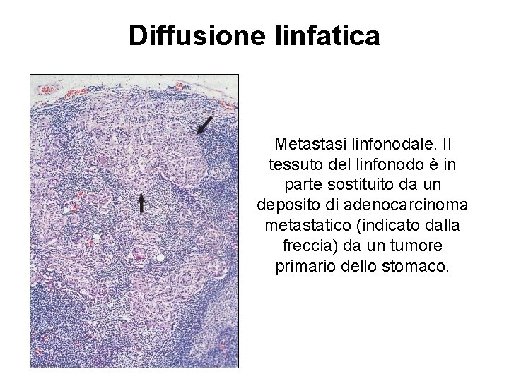 Diffusione linfatica Metastasi linfonodale. Il tessuto del linfonodo è in parte sostituito da un