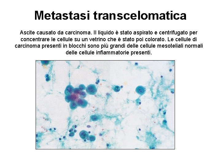 Metastasi transcelomatica Ascite causato da carcinoma. Il liquido è stato aspirato e centrifugato per