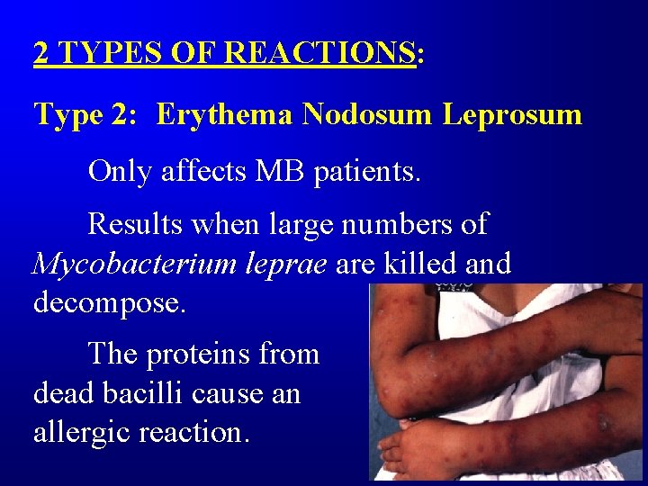 2 TYPES OF REACTIONS: Type 2: Erythema Nodosum Leprosum Only affects MB patients. Results