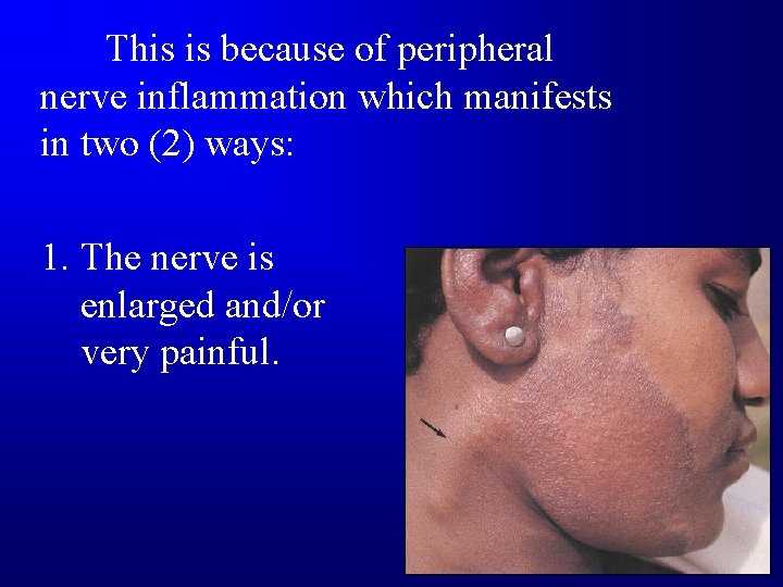 This is because of peripheral nerve inflammation which manifests in two (2) ways: 1.