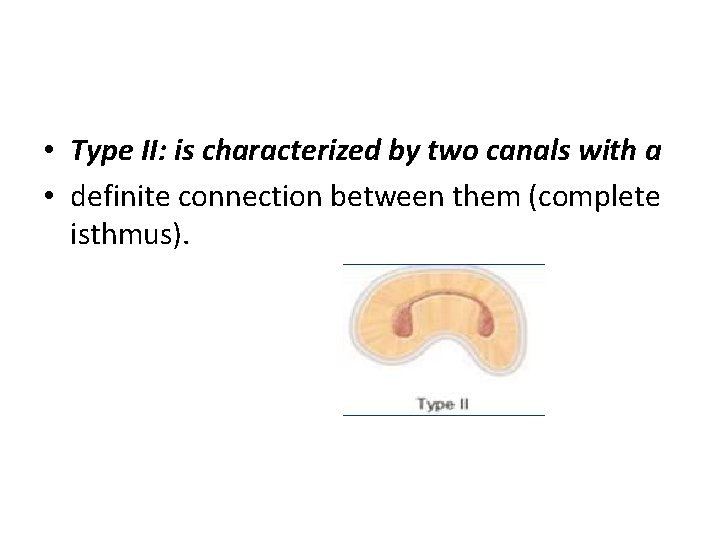  • Type II: is characterized by two canals with a • definite connection