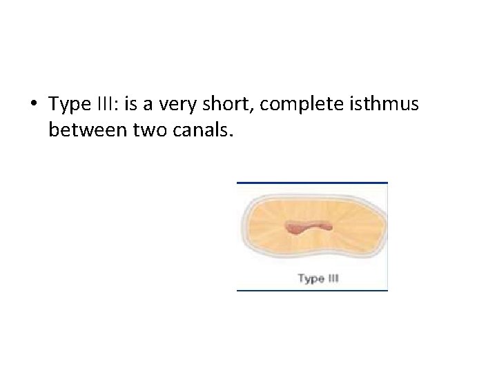  • Type III: is a very short, complete isthmus between two canals. 