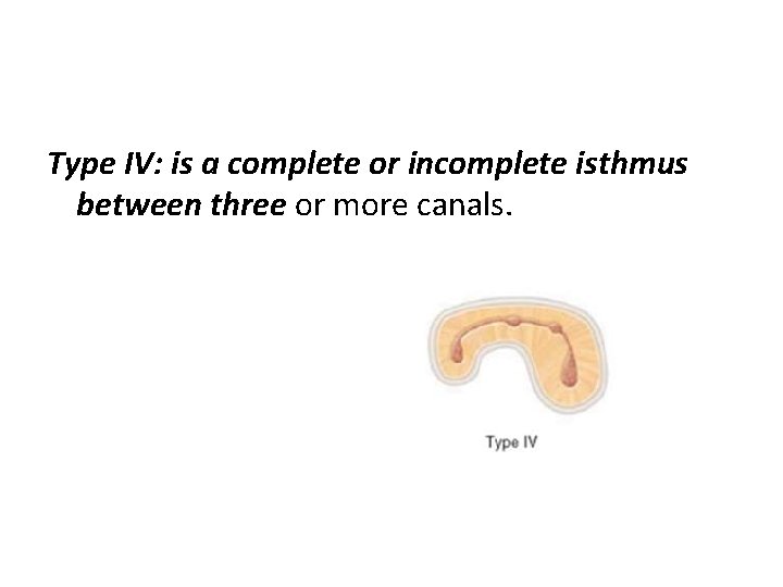 Type IV: is a complete or incomplete isthmus between three or more canals. 