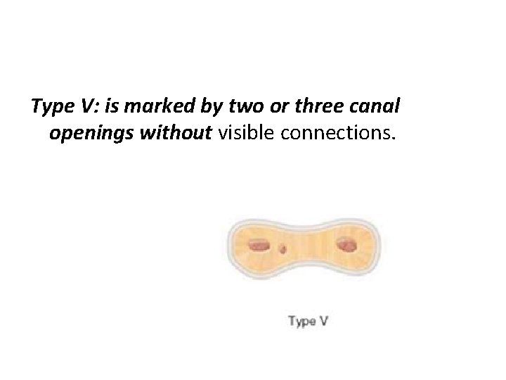 Type V: is marked by two or three canal openings without visible connections. 