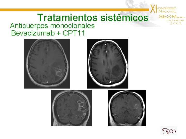 Tratamientos sistémicos Anticuerpos monoclonales Bevacizumab + CPT 11 