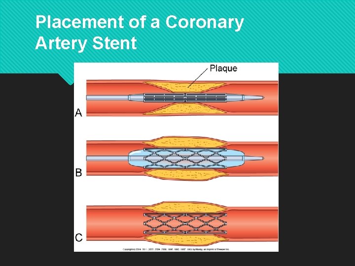 Placement of a Coronary Artery Stent Copyright © 2014 by Mosby, an imprint of