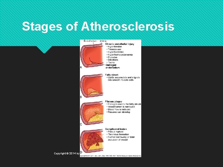Stages of Atherosclerosis Copyright © 2014 by Mosby, an imprint of Elsevier Inc. 
