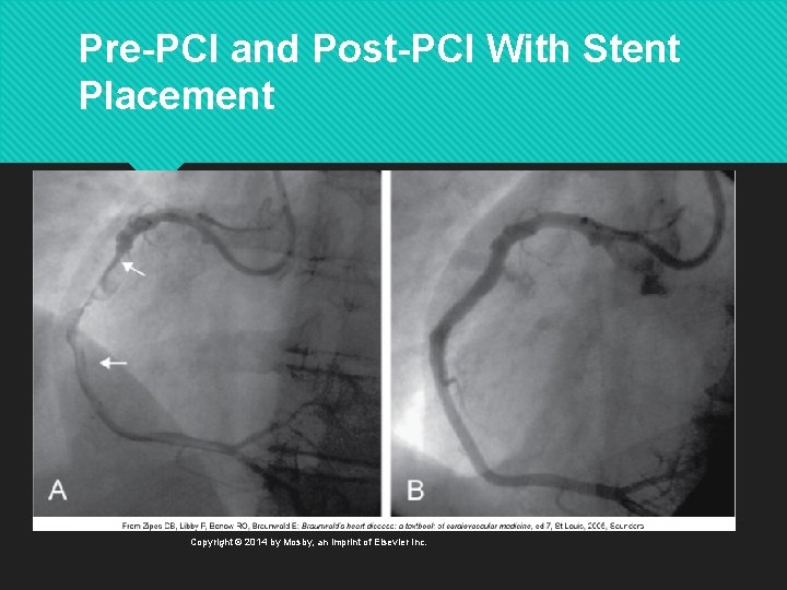 Pre-PCI and Post-PCI With Stent Placement Copyright © 2014 by Mosby, an imprint of