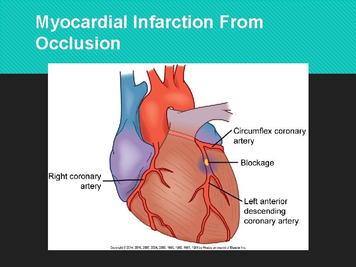 Myocardial Infarction From Occlusion Copyright © 2014 by Mosby, an imprint of Elsevier Inc.