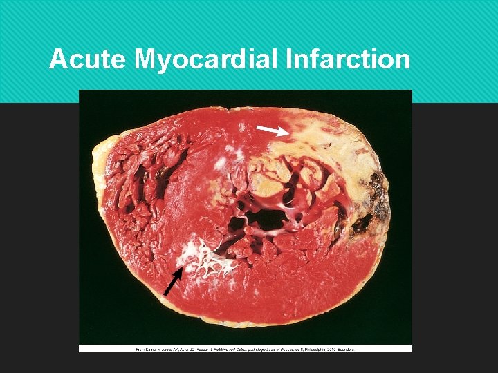 Acute Myocardial Infarction Copyright © 2014 by Mosby, an imprint of Elsevier Inc. 