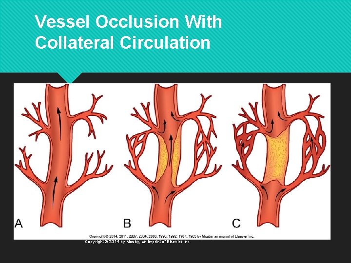 Vessel Occlusion With Collateral Circulation Copyright © 2014 by Mosby, an imprint of Elsevier