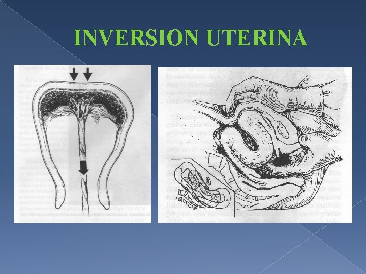 INVERSION UTERINA 