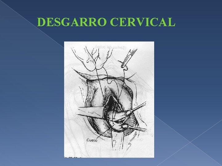 DESGARRO CERVICAL 