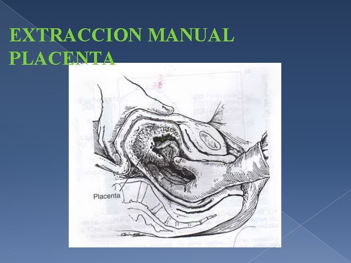 EXTRACCION MANUAL PLACENTA 