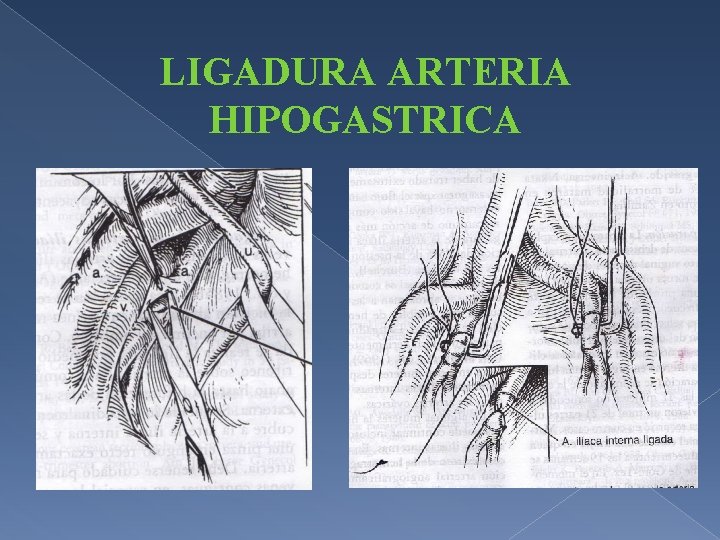 LIGADURA ARTERIA HIPOGASTRICA 