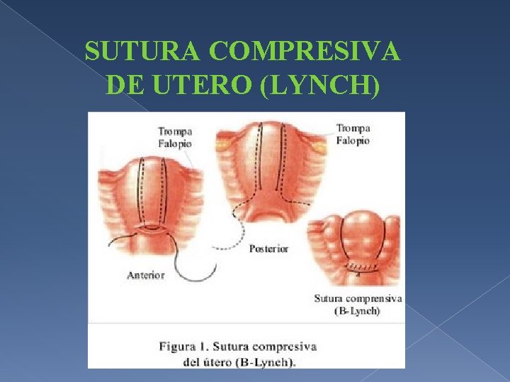 SUTURA COMPRESIVA DE UTERO (LYNCH) 