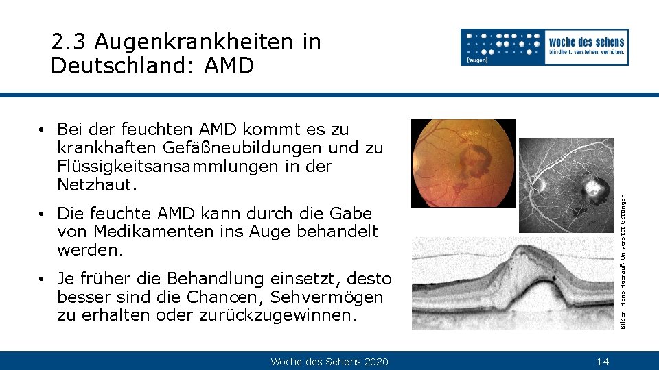 2. 3 Augenkrankheiten in Deutschland: AMD Bilder: Hans Hoerauf, Universität Göttingen • Bei der