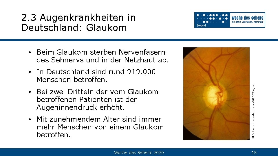 2. 3 Augenkrankheiten in Deutschland: Glaukom • Beim Glaukom sterben Nervenfasern des Sehnervs und