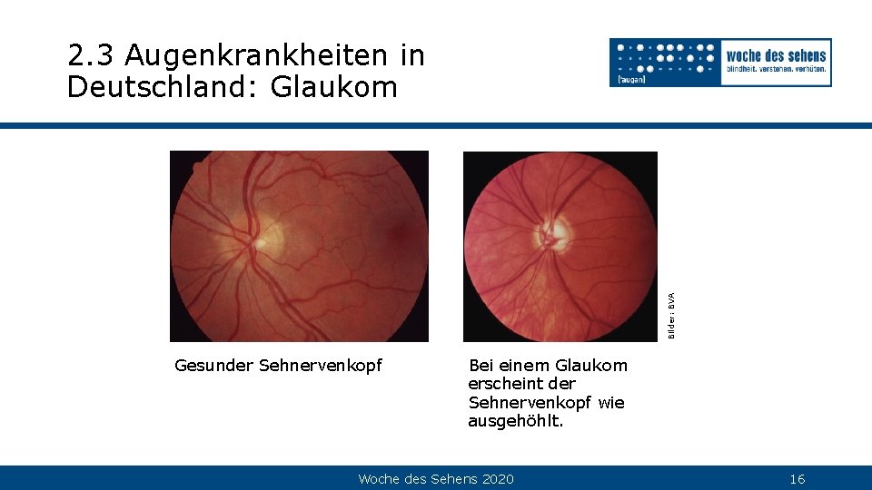 Bilder: BVA 2. 3 Augenkrankheiten in Deutschland: Glaukom Gesunder Sehnervenkopf Bei einem Glaukom erscheint