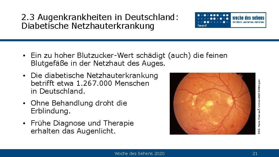 2. 3 Augenkrankheiten in Deutschland: Diabetische Netzhauterkrankung • Die diabetische Netzhauterkrankung betrifft etwa 1.