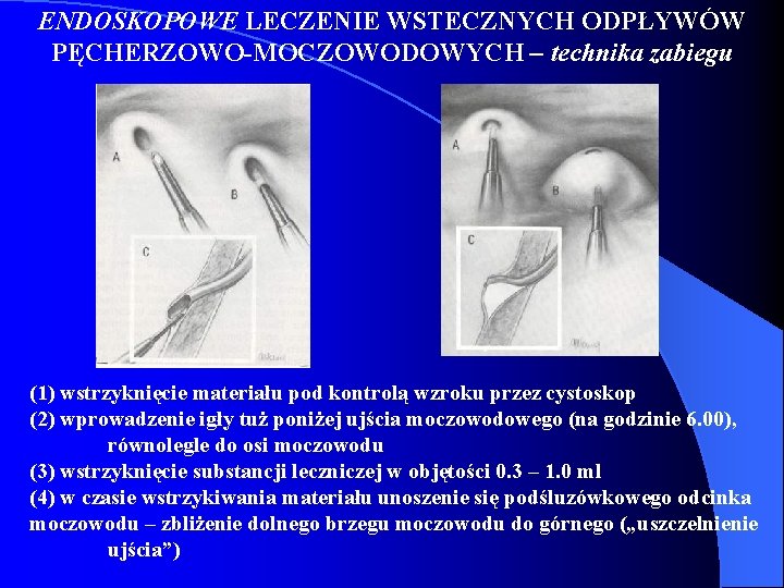 ENDOSKOPOWE LECZENIE WSTECZNYCH ODPŁYWÓW PĘCHERZOWO-MOCZOWODOWYCH – technika zabiegu (1) wstrzyknięcie materiału pod kontrolą wzroku