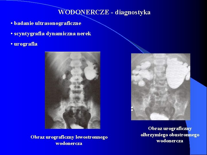 WODONERCZE - diagnostyka • badanie ultrasonograficzne • scyntygrafia dynamiczna nerek • urografia Obraz urograficzny