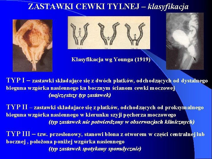 ZASTAWKI CEWKI TYLNEJ – klasyfikacja Klasyfikacja wg Younga (1919) TYP I – zastawki składające