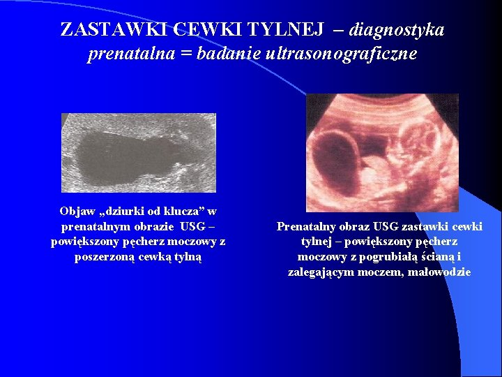 ZASTAWKI CEWKI TYLNEJ – diagnostyka prenatalna = badanie ultrasonograficzne Objaw „dziurki od klucza” w