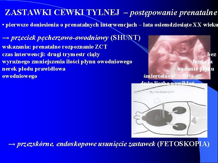 ZASTAWKI CEWKI TYLNEJ – postępowanie prenatalne • pierwsze doniesienia o prenatalnych interwencjach – lata