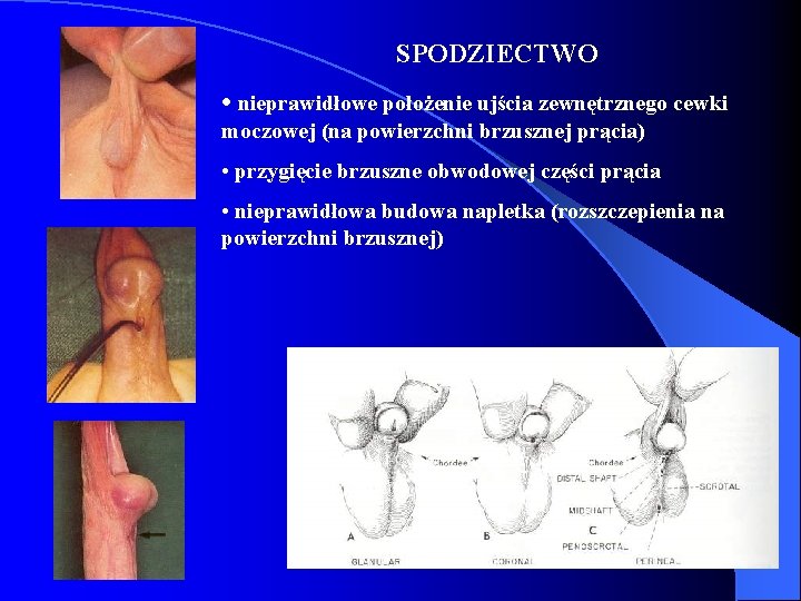 SPODZIECTWO • nieprawidłowe położenie ujścia zewnętrznego cewki moczowej (na powierzchni brzusznej prącia) • przygięcie