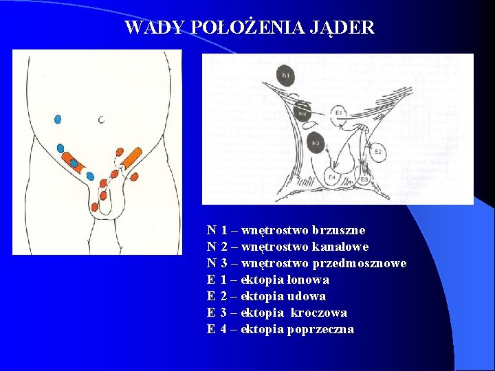 WADY POŁOŻENIA JĄDER N 1 – wnętrostwo brzuszne N 2 – wnętrostwo kanałowe N