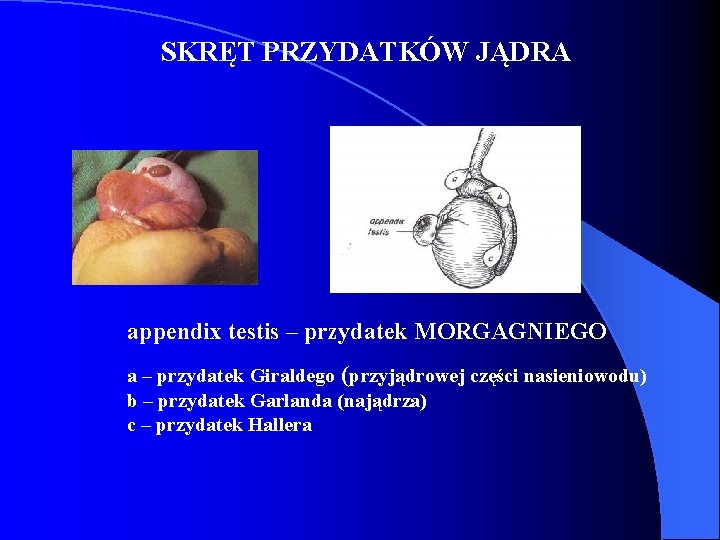 SKRĘT PRZYDATKÓW JĄDRA appendix testis – przydatek MORGAGNIEGO a – przydatek Giraldego (przyjądrowej części