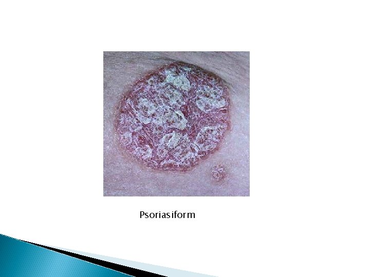 Psoriasiform Psoriasiform